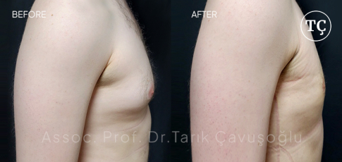Gynecomastia Before After