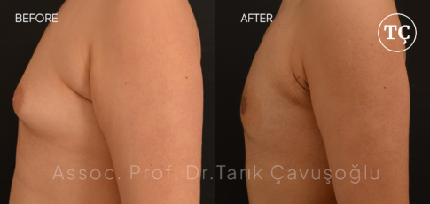 Gynecomastia Before After