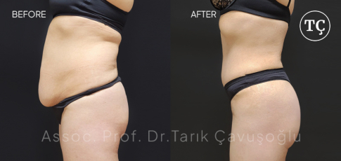 Tummy Tuck Before After