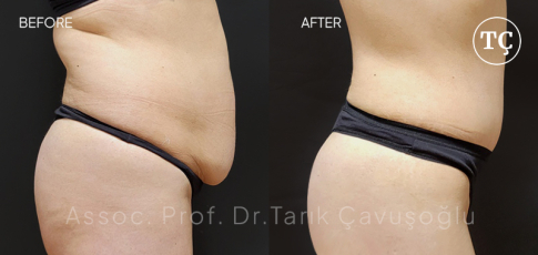 Tummy Tuck Before After