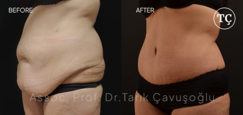 Tummy Tuck Before After