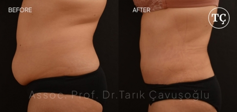 Tummy Tuck Before After