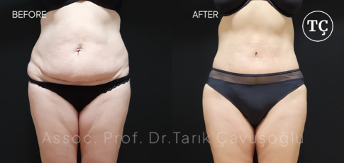 Tummy Tuck Before After