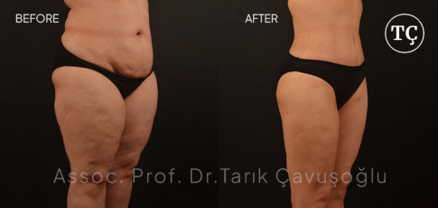 Tummy Tuck Before After
