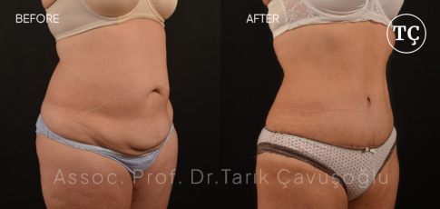 Tummy Tuck Before After