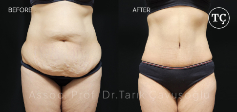 Tummy Tuck Before After