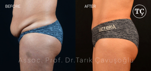 Tummy Tuck Before After