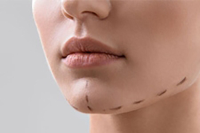 Çene Botoksu Sonrası