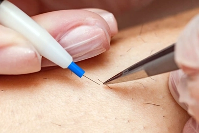 Differences Between Electrolysis and Laser Hair Removal