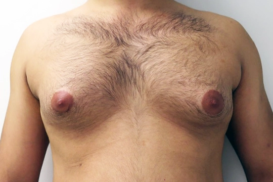 Erkek Göğsünü Büyüten Görünmez Kimyasallar: Jinekomastinin Yeni Yüzü