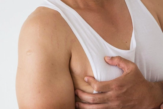 Erkeklerde Meme Büyümesi (Jinekomasti) Neden Olur?