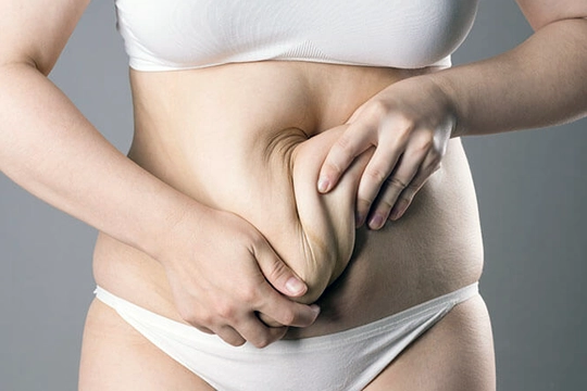 Karın Germe Ameliyatı Nedir?