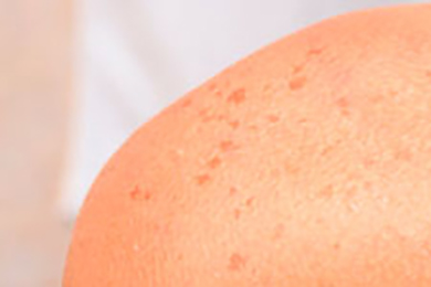 Lazer Epilasyon Sonrası Leke