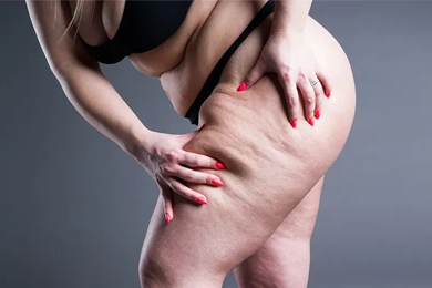 Lipödem-Behandlung mit VASERLipo (Vaser Liposuction)